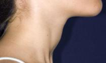 Cauzele, tratamentul și consecințele măririi tiroidei
